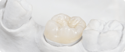 Facettes céramiques au cabinet dentaire du dr Cristian Kelemen